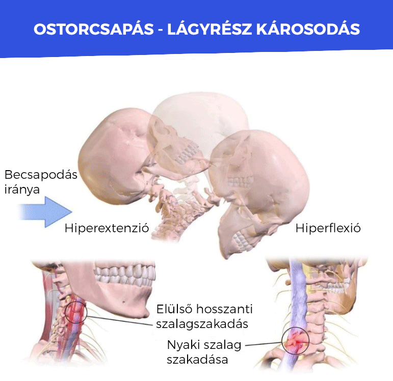 ostorcsapas