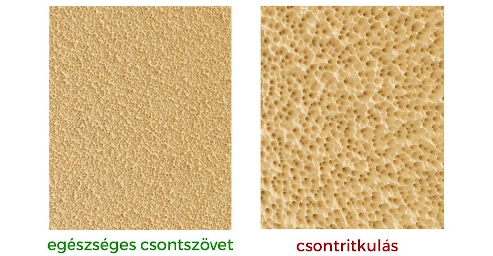A csontritkulás nem az időskorral kezdődik