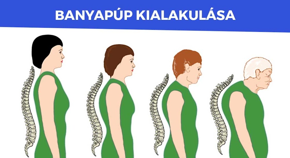 A csontritkulás nem az időskorral kezdődik