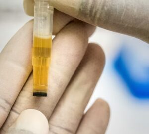 jelezheti e a vizeletunk a demencia kockazatat