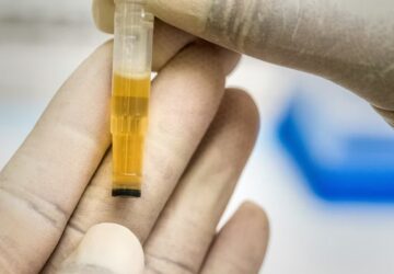 jelezheti e a vizeletunk a demencia kockazatat